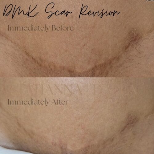 DMK Scar Treatment at DAELA Scottsdale