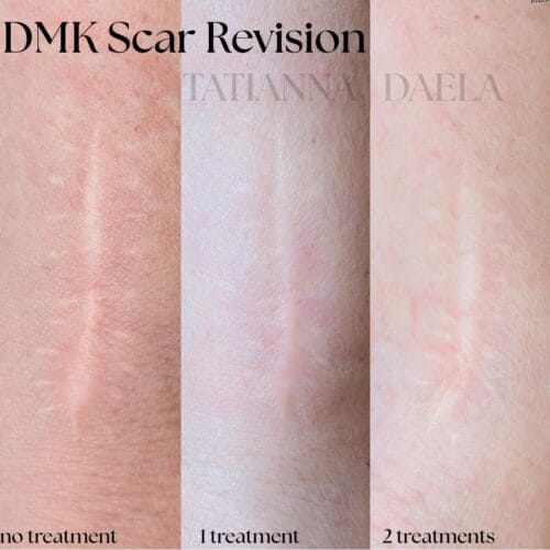 DMK Scar Treatment at DAELA Scottsdale