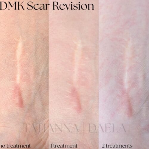 DMK Scar Treatment at DAELA Scottsdale