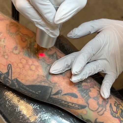 Laser tattoo Removal at DAELA