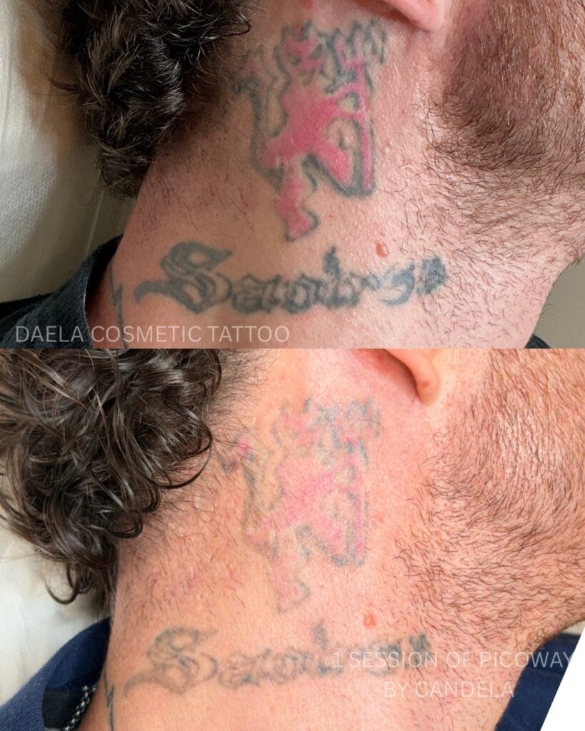 Is It Possible to 100% Remove a Tattoo?