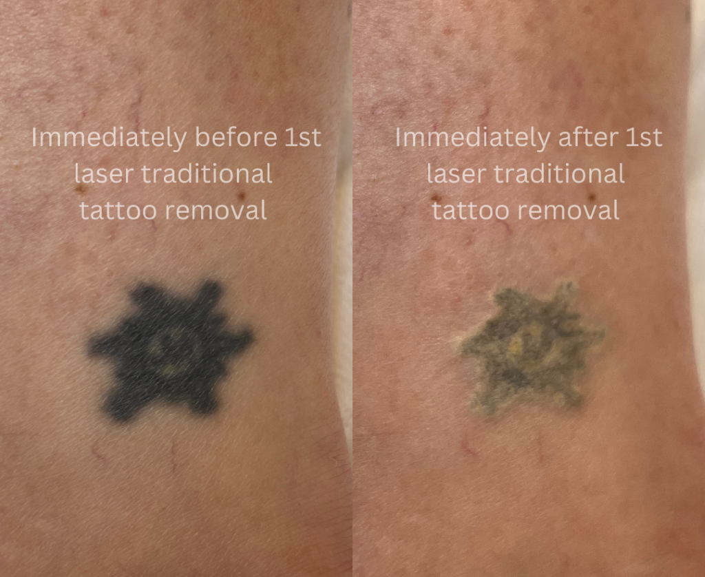Is It Possible to 100% Remove a Tattoo?