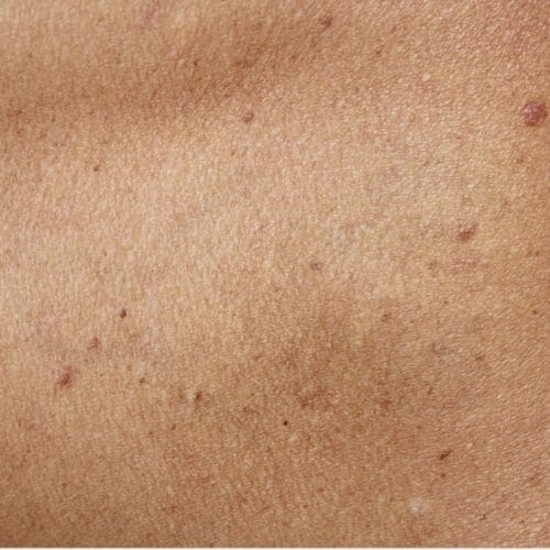 Is It Possible to 100% Remove a Tattoo?
