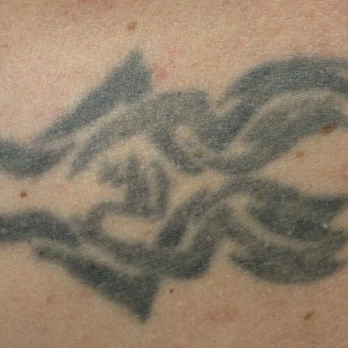 Is It Possible to 100% Remove a Tattoo?