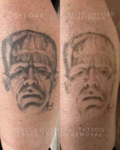 Laser tattoo Removal DAELA Cosmetic Tattoo