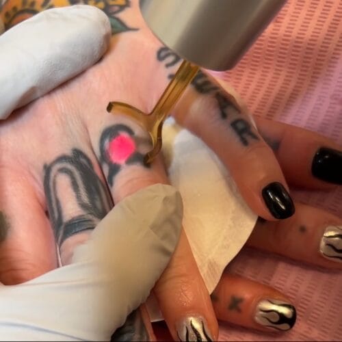 How Much Does It Cost to Laser Off a Tattoo?